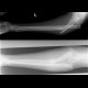 Monteggia fracture: X-ray - Plain radiograph